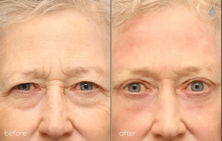 Front before and after UPPER FACE REJUVENATION Dr. Farhood