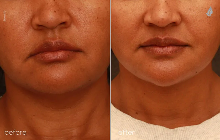 Front profile before and after Deep plane face & neck lift and buccal fat removal by Dr. Farhood