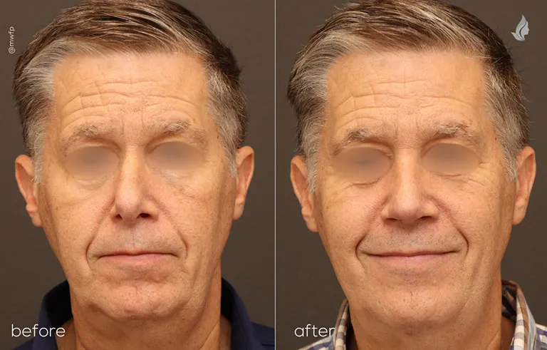 Frontal profile before and after Rhinoplasty By Dr. Farhood