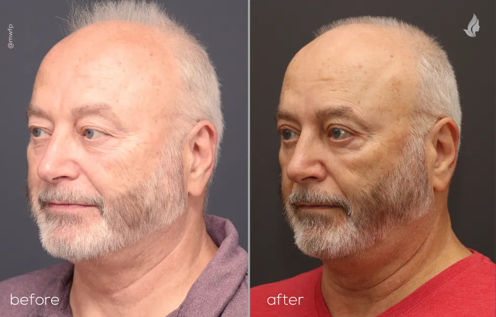 Left Oblique Upper Bleph By Dr. Farhood