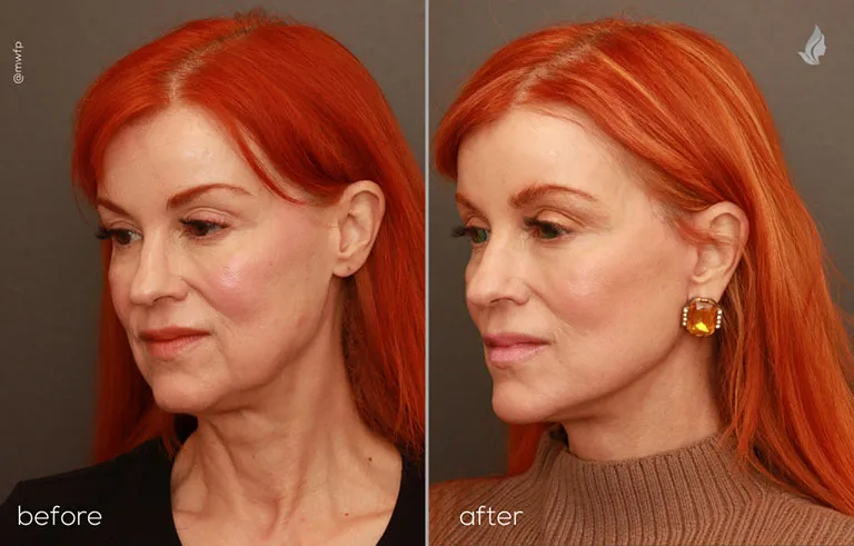 Oblique Left before after deep plane facelift by Dr. Bakeman