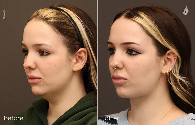 Oblique Left before and after Neck Lift by Dr. Bakeman