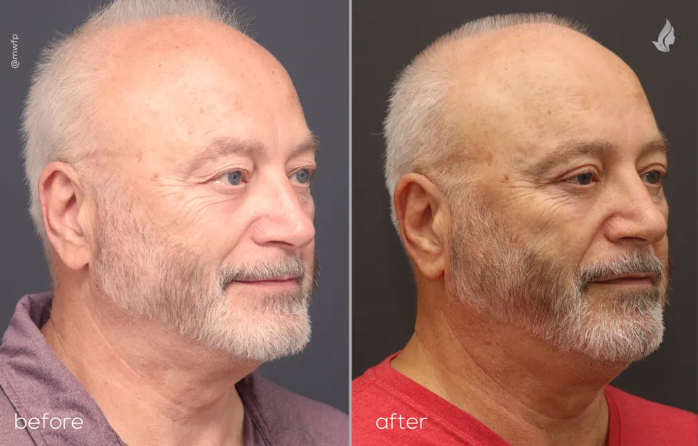 Right Oblique Upper Bleph By Dr. Farhood