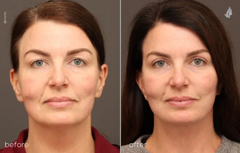 front before and after Upper eyelid lift and lower facelift by Dr. Griffin