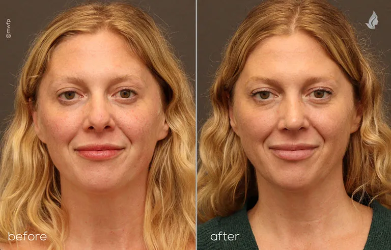 front profile before and after Rhinoplasty By Dr. Farhood