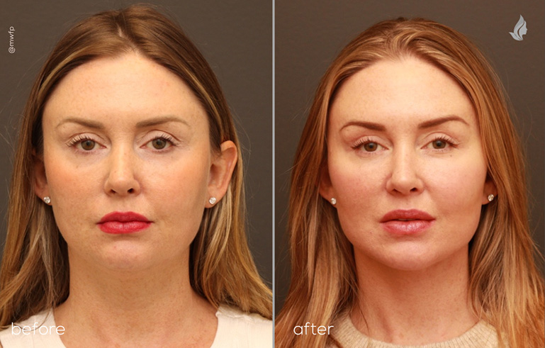 front view lower facelift upper blepharoplasty small chin implant by Dr. Griffin