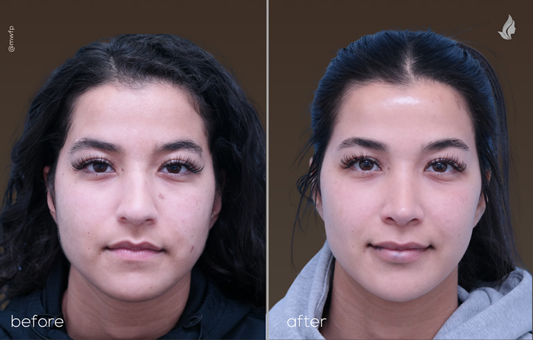 front view reconstructive rhinoplasty by Dr Tolan