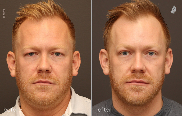 Front View Billateral Upper Blepharoplasty before and after by Dr. Griffin