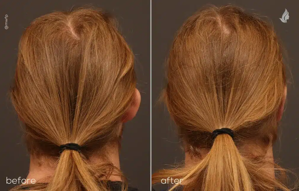 Back View otoplasty before and after by Dr. Bakeman