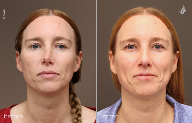 Front View Rivision Rhinoplasty before and after by Dr. Farhood