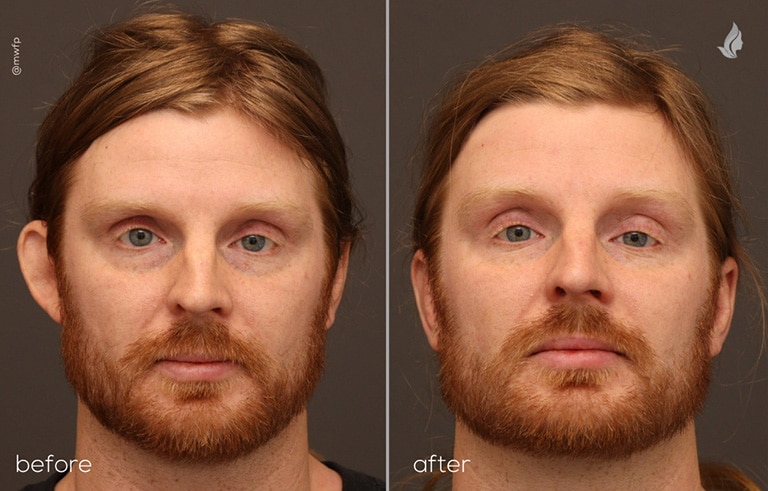 Front View otoplasty before and after by Dr. Bakeman