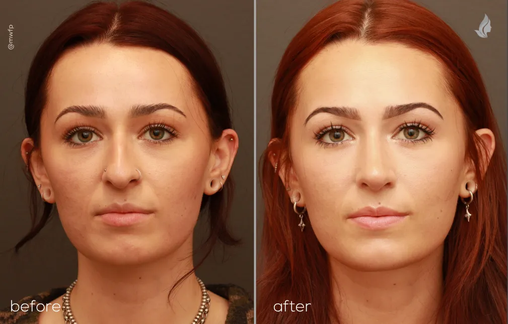 Front View Cosmetic and functional Rhinoplasty before and after by Dr. Griffin